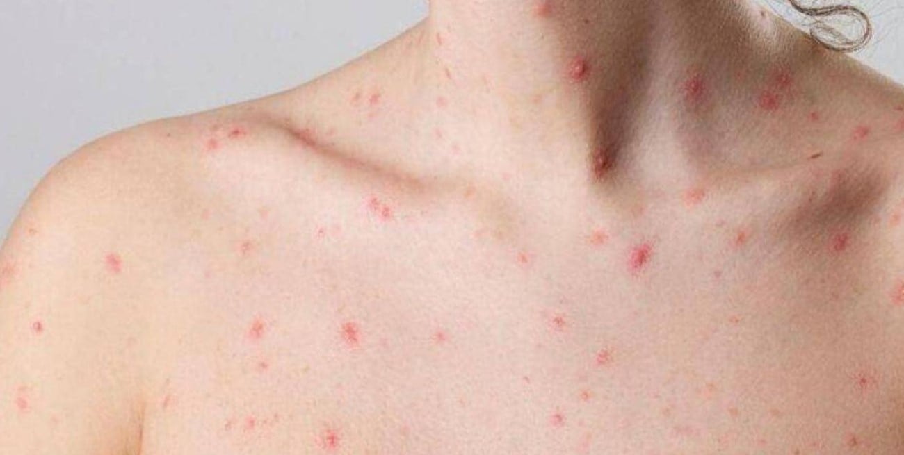Confirmaron el primer caso de la nueva variante de viruela símica en Argentina