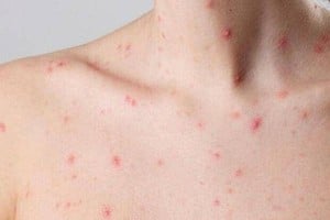 Confirmaron el primer caso de la nueva variante de viruela símica en Argentina.