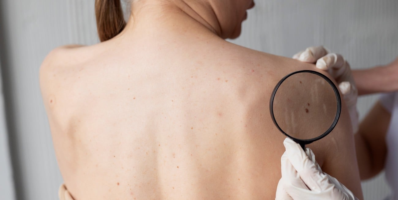 Cómo detectar si un lunar es peligroso y cuándo consultar al especialista