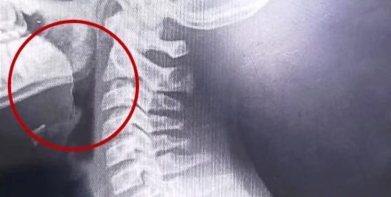 Escupió sangre después de ingerir una galletita y descubrieron un objeto en su garganta