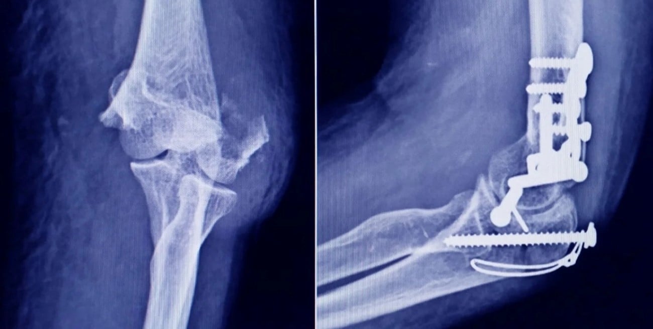 Anmat prohíbe insumos traumatológicos por falsificación y falta de control sanitario