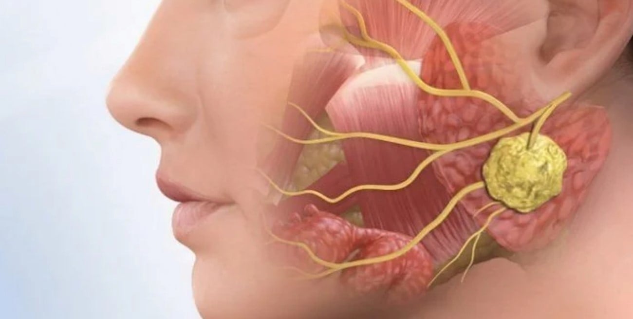 Cistoadenoma parotídeo bilateral: claves de la enfermedad y cómo es la cirugía de remoción