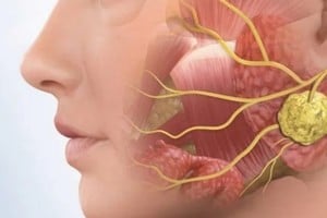 Cistoadenoma parotídeo bilateral: claves de la enfermedad y cómo es la cirugía de remoción