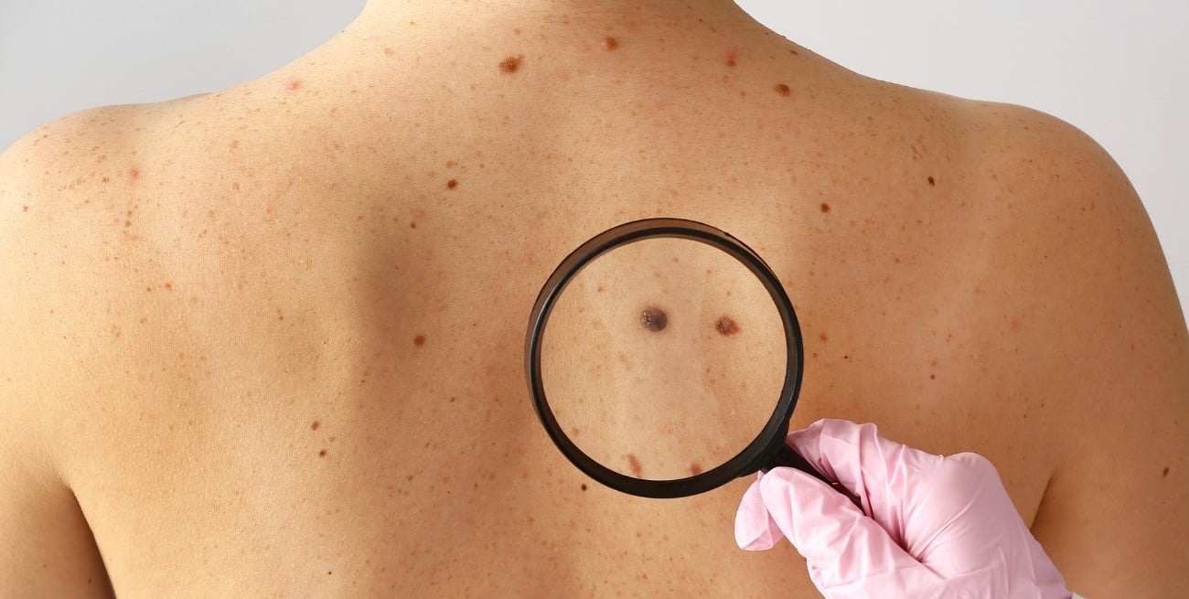 Melanoma: el cáncer de piel que más crece entre jóvenes y que muchos siguen ignorando