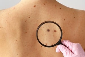 Especialistas alertan sobre el aumento sostenido de este tipo de tumor en Argentina y en el mundo.