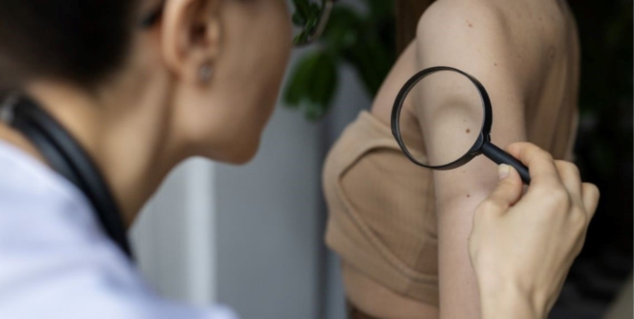 Día Mundial del Cáncer de Piel: Prevención Salud promueve el cuidado y la detección temprana