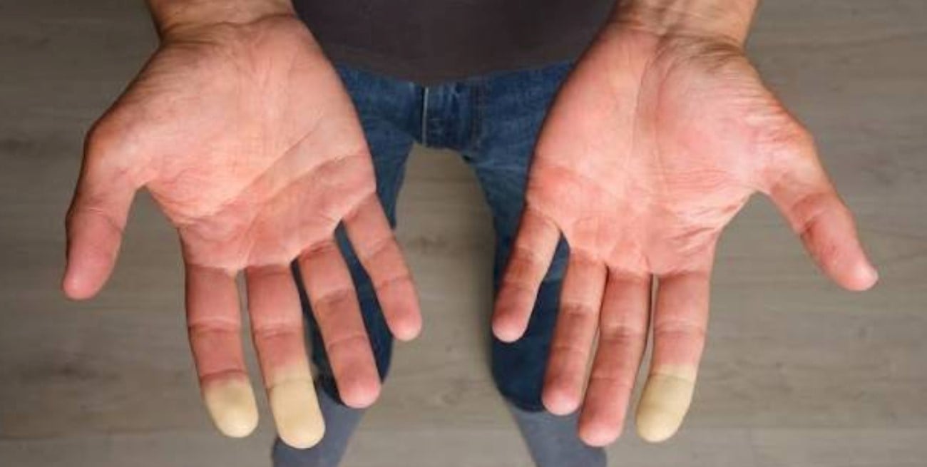 Esclerodermia: cuáles son los primeros síntomas y por qué es clave un diagnóstico temprano