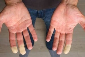 Una de las primeras manifestaciones de la enfermedad suele ser el fenómeno de Raynaud